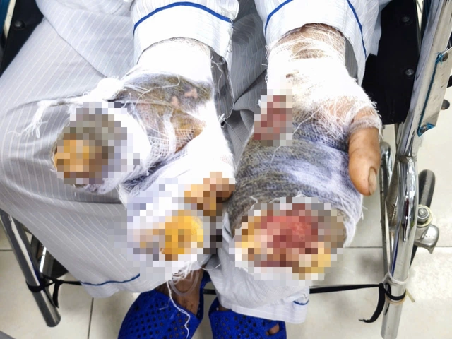 Người phụ nữ Hưng Yên bị chó nhà nuôi tấn công khi đang cho ăn